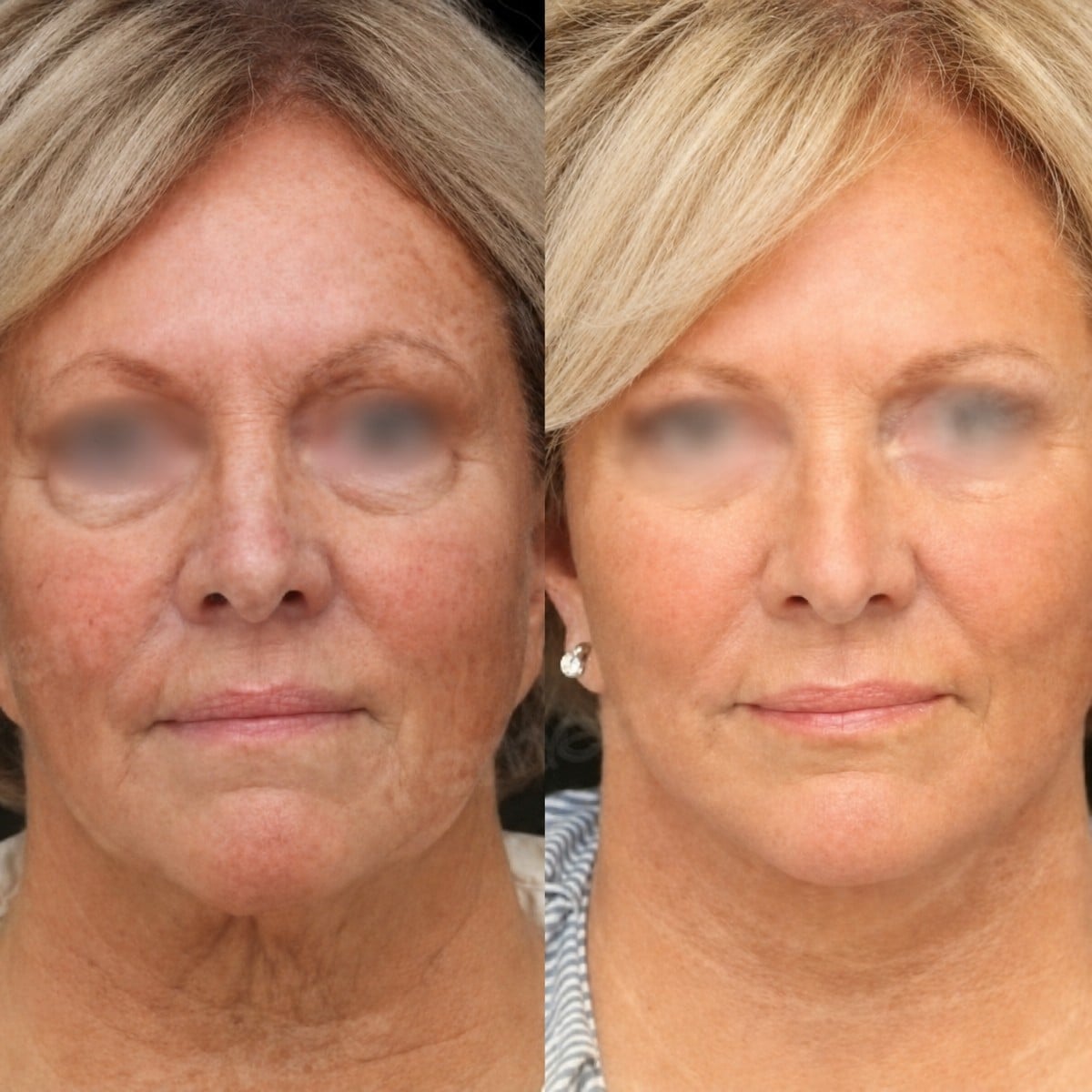 Resultados de minilifting facial antes y después en Memorial Bahçelievler Hospital, rejuvenecimiento