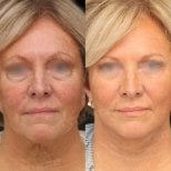 Before and after mini facelift results at Memorial Bahçelievler Hospital, facial rejuvenation