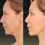 Before and after mini facelift results at Memorial Bahçelievler Hospital, facial rejuvenation