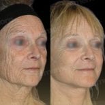 Before and after mini facelift results at Memorial Bahçelievler Hospital, facial rejuvenation