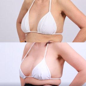 Before and after breast lift results at Dr. Chen Surgery Hospital International Center