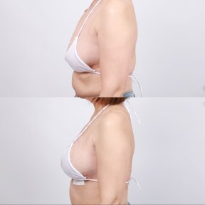 Before and after breast lift results at Dr. Chen Surgery Hospital International Center, improved contour