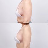 Before and after breast lift results at Dr. Chen Surgery Hospital International Center, improved contour