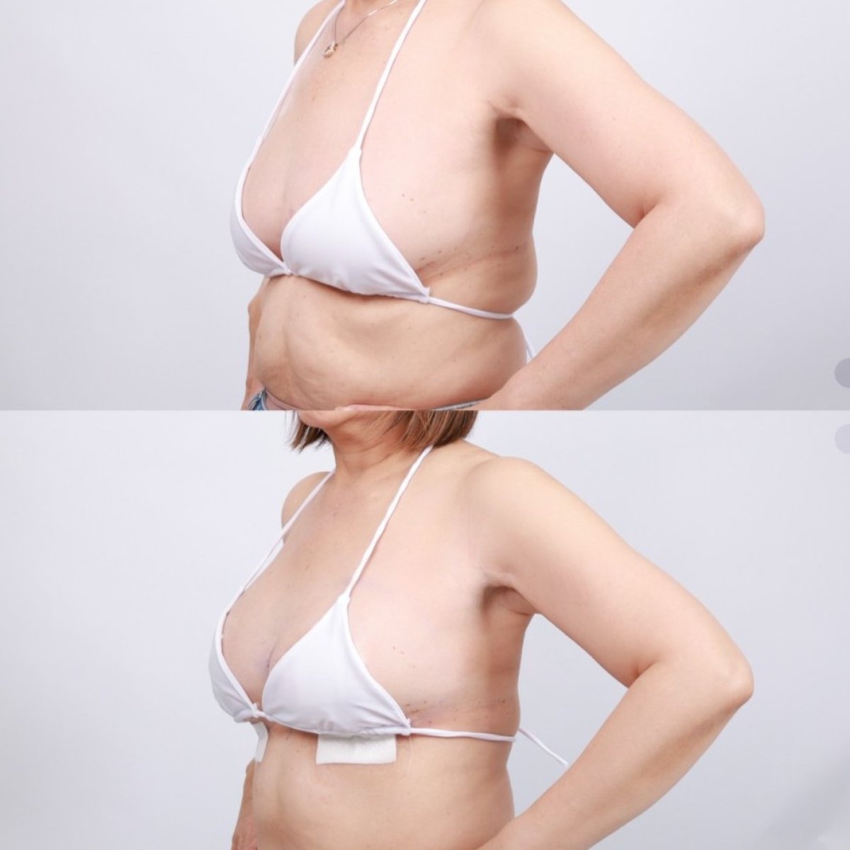 Resultados antes y después de mastopexia en Dr. Chen Surgery Hospital International Center