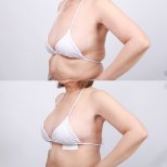 Before and after breast lift results at Dr. Chen Surgery Hospital International Center