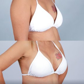 Before and after breast lift results at Dr. Chen Surgery Hospital International Center