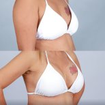 Before and after breast lift results at Dr. Chen Surgery Hospital International Center