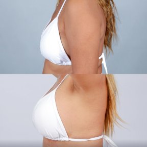 Before and after breast lift results at Dr. Chen Surgery Hospital International Center