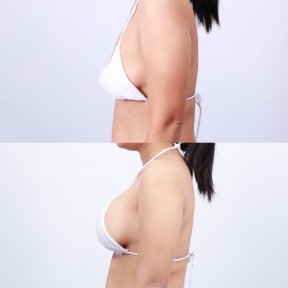 Before and after breast lift results at Dr. Chen Surgery Hospital International Center