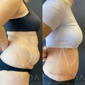Vorher-nachher-Liposuktionsergebnis bei Liv Hospital Ulus, sichtbare Bauchkonturverbesserung