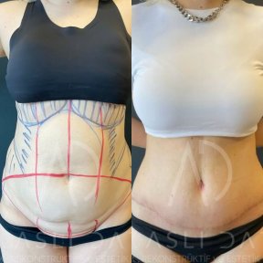 Liposuktion Vorher-Nachher-Ergebnis bei Liv Hospital Ulus, sichtbare Bauchkontur-Verbesserung