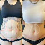 Liposuktion Vorher-Nachher-Ergebnis bei Liv Hospital Ulus, sichtbare Bauchkontur-Verbesserung