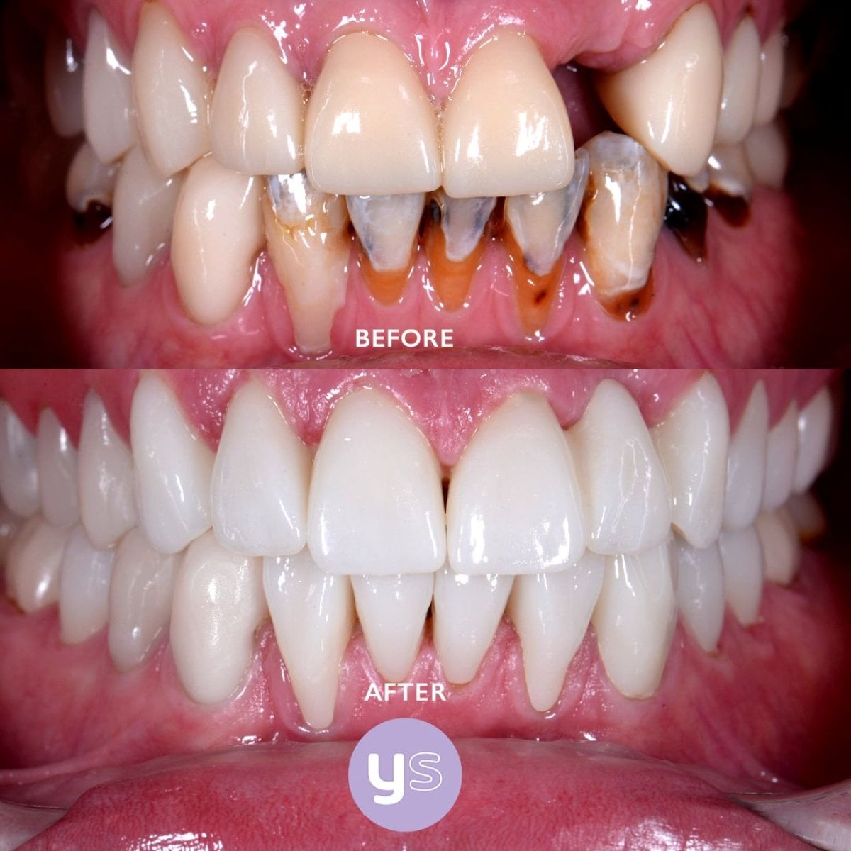 نتائج قبل وبعد جسر الأسنان الزركوني في YeahSmile – ابتسامة صحية مستعادة