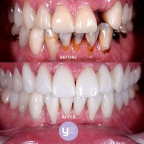 Before and after zirconia dental bridge results at YeahSmile – restored healthy white smile