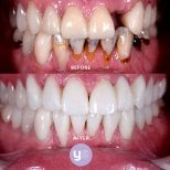 Before and after zirconia dental bridge results at YeahSmile – restored healthy white smile