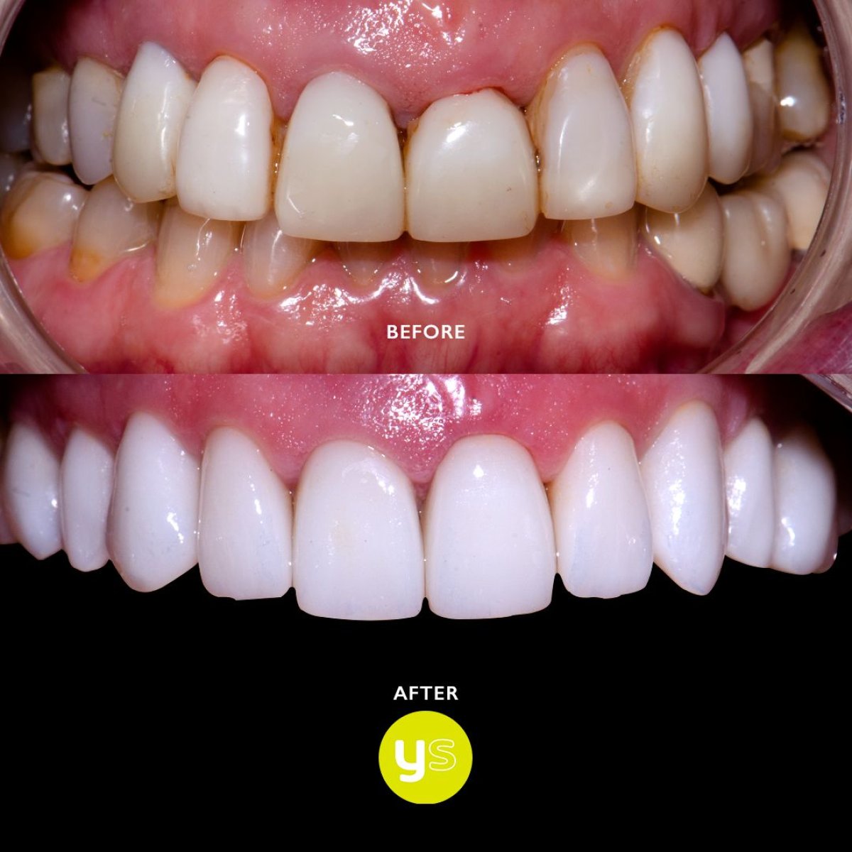 نتائج قبل وبعد جسر الأسنان الزركوني في YeahSmile – تحسين جمالية الابتسامة