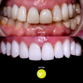 Before and after zirconia dental bridge results at YeahSmile – improved smile aesthetics