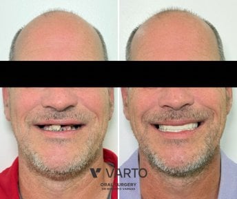 Before and after Immediate Load All-on-6 dental implants result at Varto Oral Surgery clinic