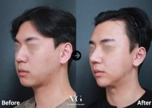 Результат ультразвуковой ринопластики до и после в VG Plastic Surgery, улучшен контур носа