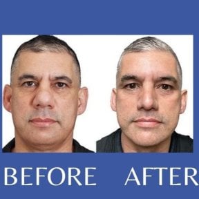 Before and after revision rhinoplasty result at ID Clinic Bangkok, improved nose shape