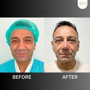 Before and after revision rhinoplasty results at ID Clinic Bangkok, improved nose shape