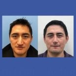 Before and after revision rhinoplasty result at ID Clinic Bangkok, improved nose shape