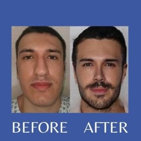 Before and after revision rhinoplasty result at ID Clinic Bangkok, improved nose shape