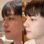 Результаты до и после ультразвуковой ринопластики в VG Plastic Surgery, улучшена форма носа