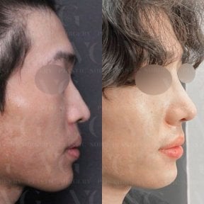 Результаты до и после ультразвуковой ринопластики в VG Plastic Surgery, улучшенный профиль носа