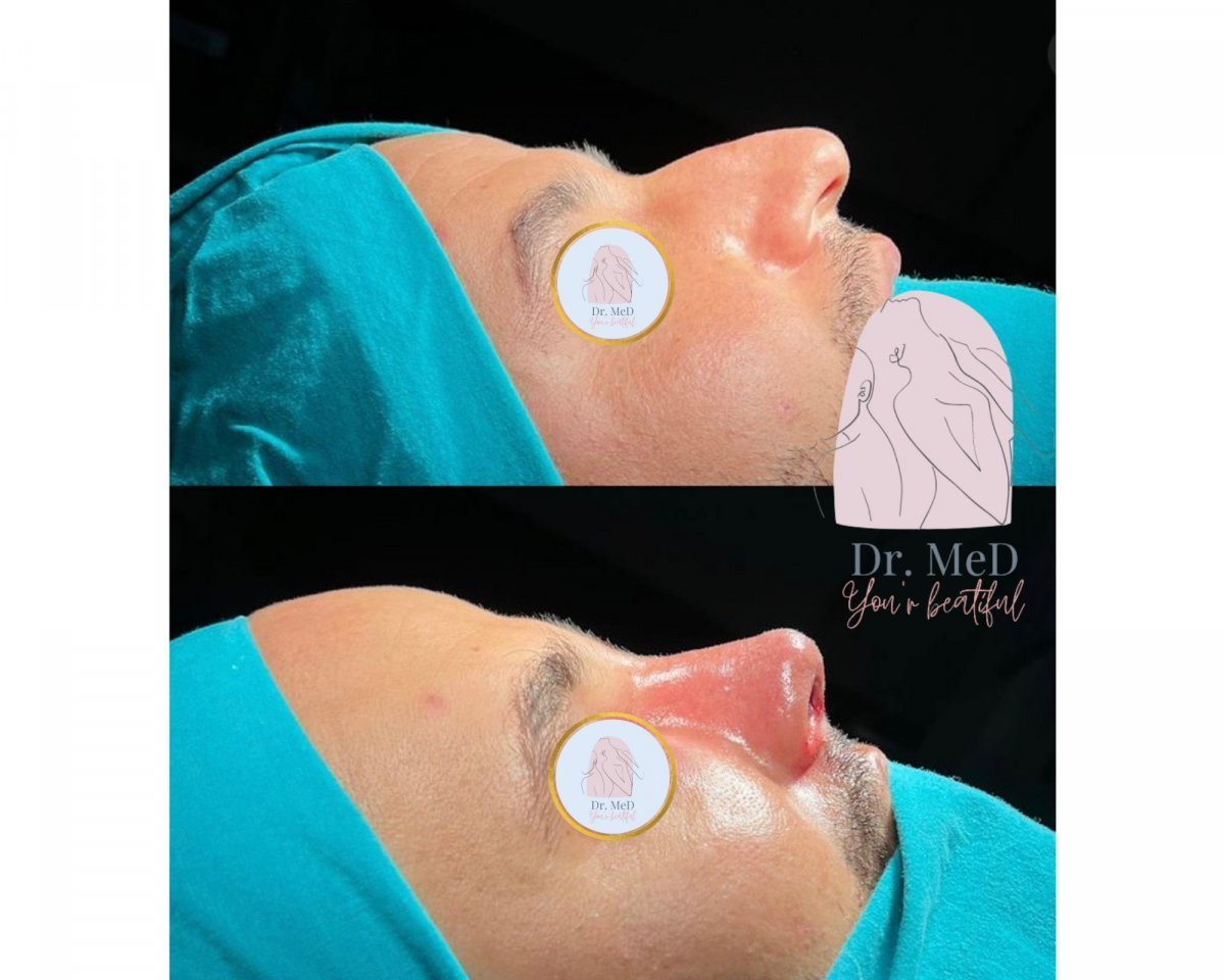 Résultats avant et après rhinoplastie chez Dr. MED, forme et profil du nez améliorés