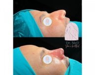 Before and after rhinoplasty results at Dr. MED, improved nose shape and profile