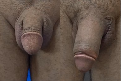 Before and after Himplant penis enlargement surgery results at Uroaesthetic clinic