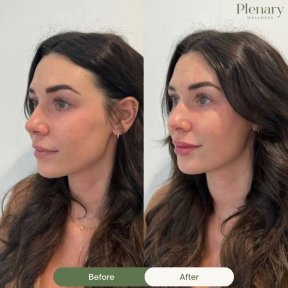 Vorher-nachher-Ergebnis Lip Lift bei Plenary Wellness, verbesserte Lippenkontur