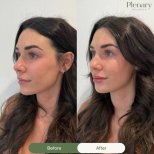 Vorher-nachher-Ergebnis Lip Lift bei Plenary Wellness, verbesserte Lippenkontur