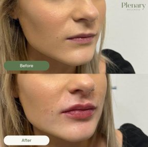 Vorher-nachher-Ergebnis Lip Lift bei Plenary Wellness, verbesserte Lippenform und Volumen