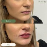 Vorher-nachher-Ergebnis Lip Lift bei Plenary Wellness, verbesserte Lippenform und Volumen