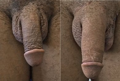 Before and after penis enlargement results at Uroaesthetic clinic, visible size improvement