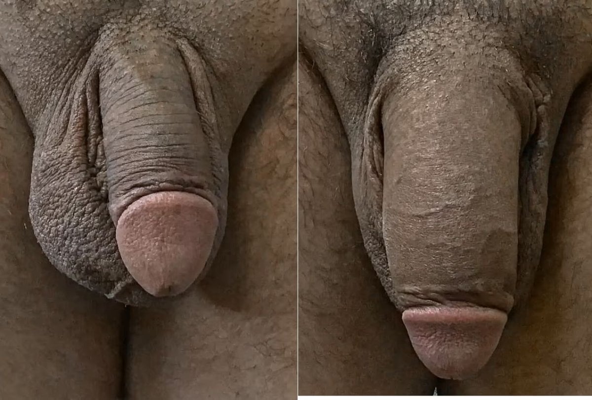 Resultados de aumento de pene antes y después en Uroaesthetic, mejora visible del tamaño