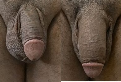 Before and after penis enlargement results at Uroaesthetic clinic, visible size improvement