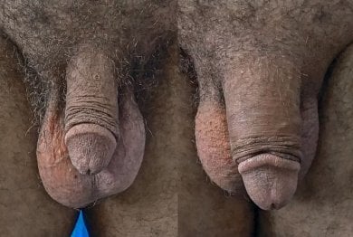 Before and after penis enlargement results at Uroaesthetic clinic, visible size improvement