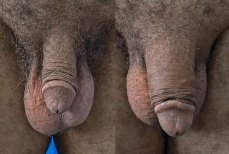 Before and after penis enlargement results at Uroaesthetic clinic, visible size improvement