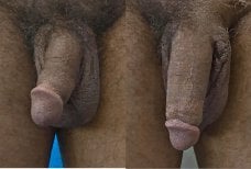 Результаты до и после увеличения пениса в клинике Uroaesthetic, видимое увеличение