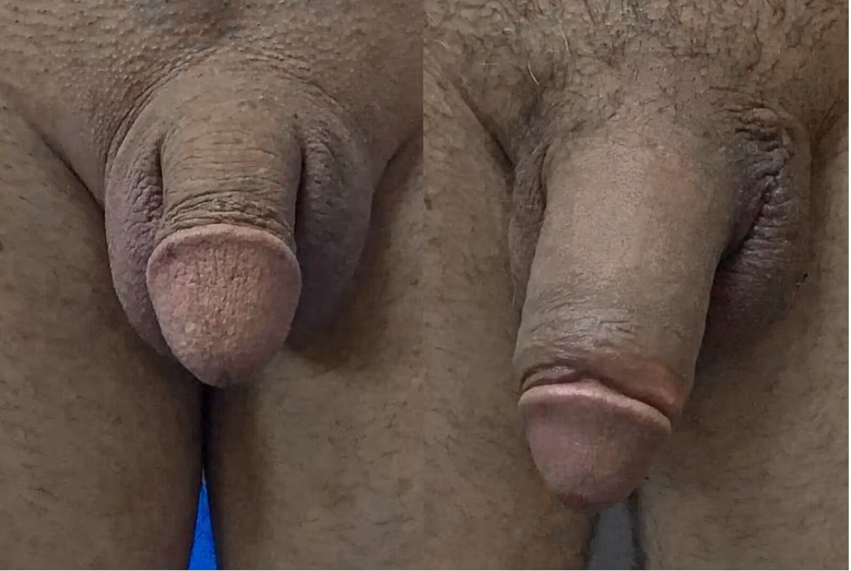 Vorher-nachher-Ergebnisse Penisvergrößerung bei Uroaesthetic, sichtbare Größenzunahme