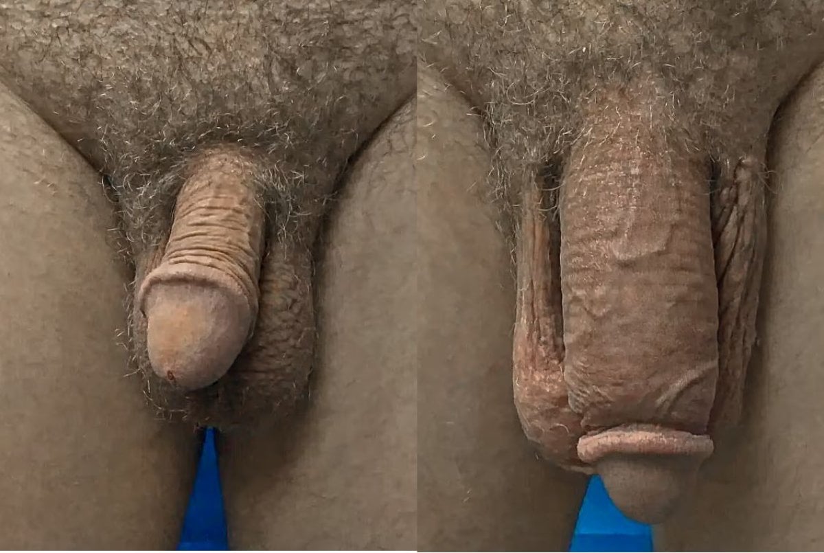 Vorher-nachher-Ergebnis Penisvergrößerung bei Uroaesthetic, sichtbare Größenzunahme