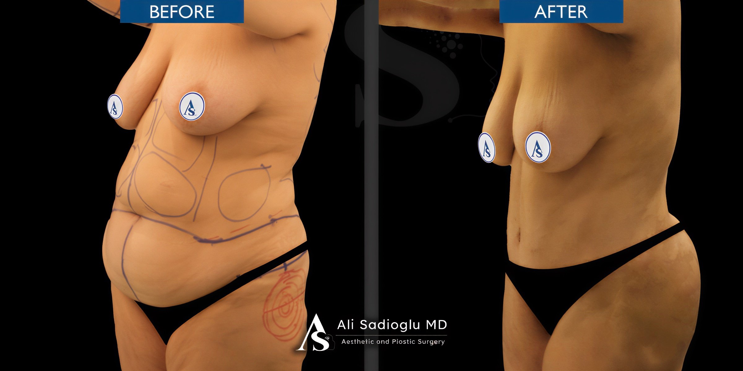 Resultados de abdominoplastia antes y después en Dr. Safa Manav Clinic, contorno abdominal visible