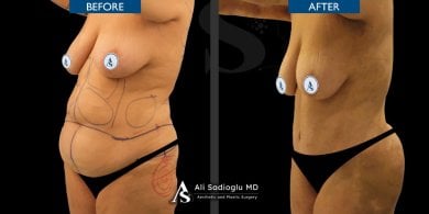 Vorher-nachher-Ergebnis Bauchdeckenstraffung bei Dr. Safa Manav Clinic, sichtbare Kontur