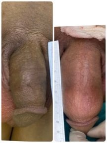 Before and after Genital PRP (O-Shot) results at ID Clinic Bangkok, visible enhancement shown