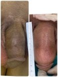 Before and after Genital PRP (O-Shot) results at ID Clinic Bangkok, visible enhancement shown