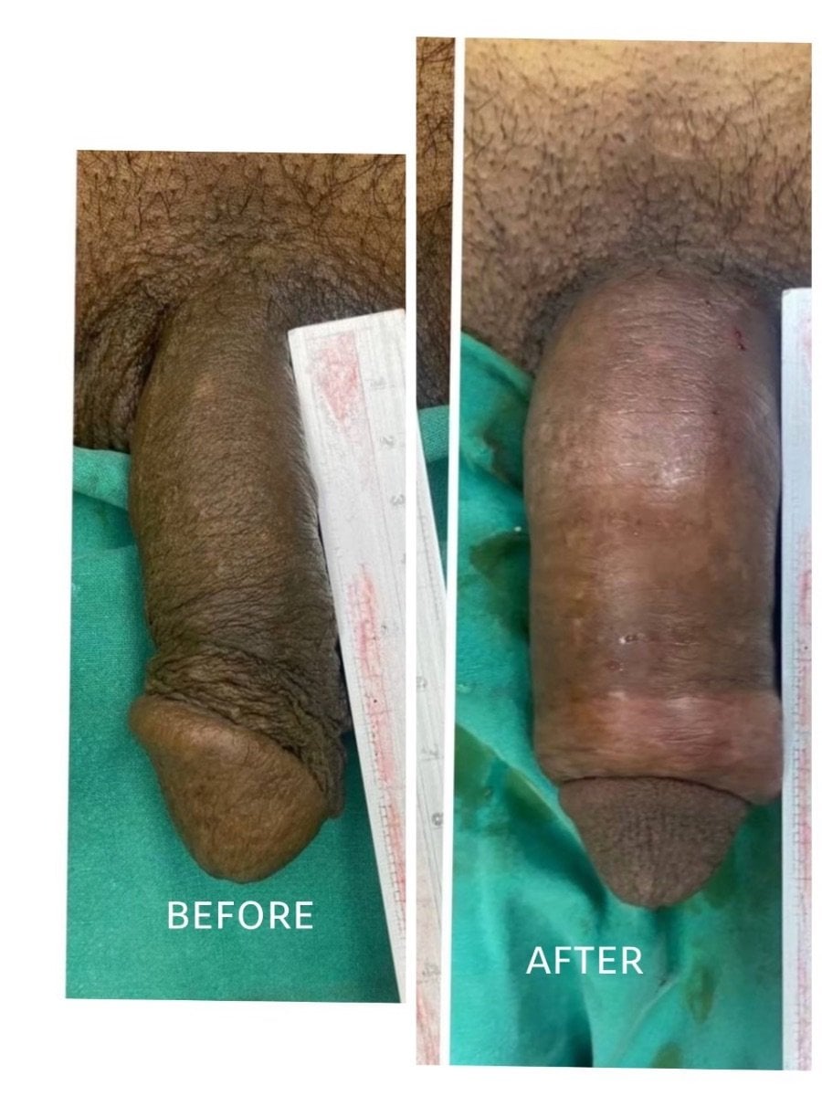 Resultados antes y después de PRP genital (O-Shot) en ID Clinic Bangkok, mejora visible