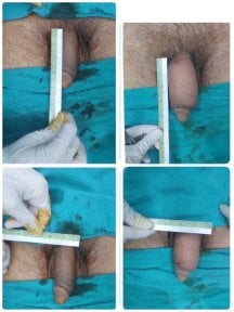 Before and after results of Genital PRP (O-Shot) at ID Clinic Bangkok, visible enhancement